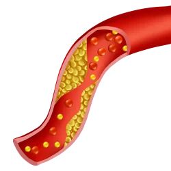 —Pngtree—arterial cholesterol blockage_6935859-min